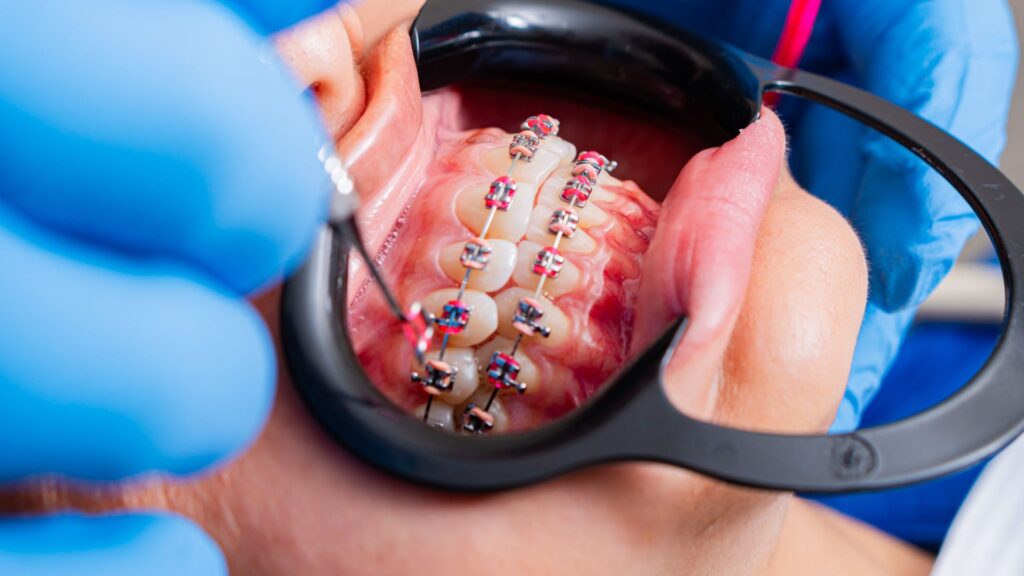 Best Braces Puns and Jokes Dirty 😳