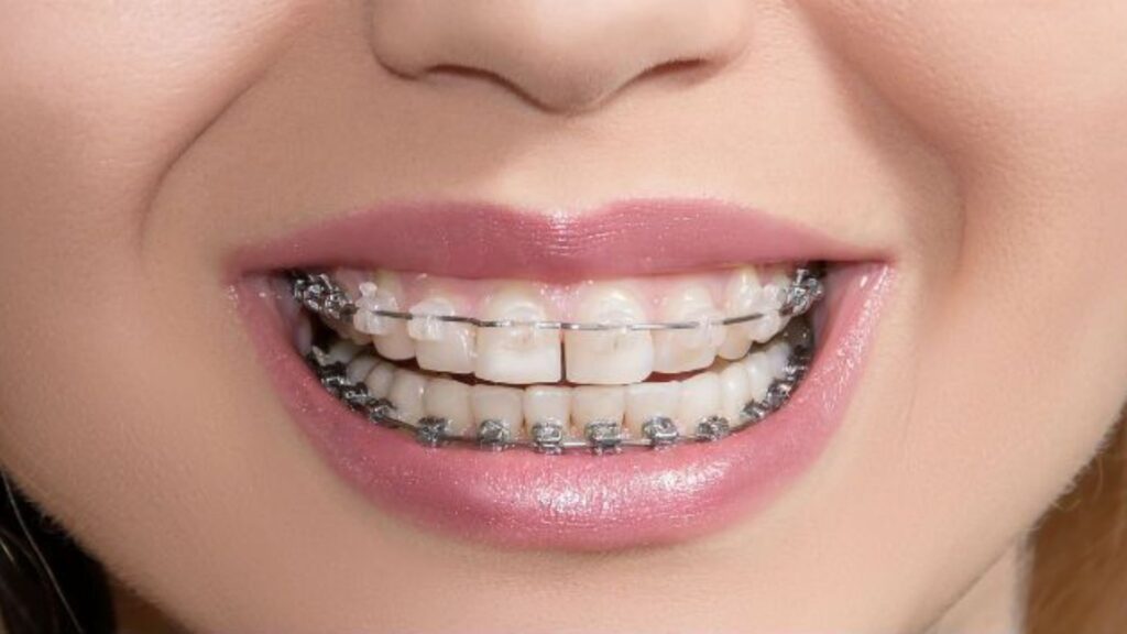 Braces Humor for Everyone 😆